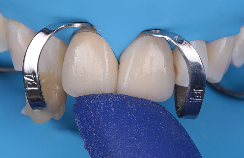 Finale Einprobe nach Trockenlegung Finale Einprobe nach Trockenlegung