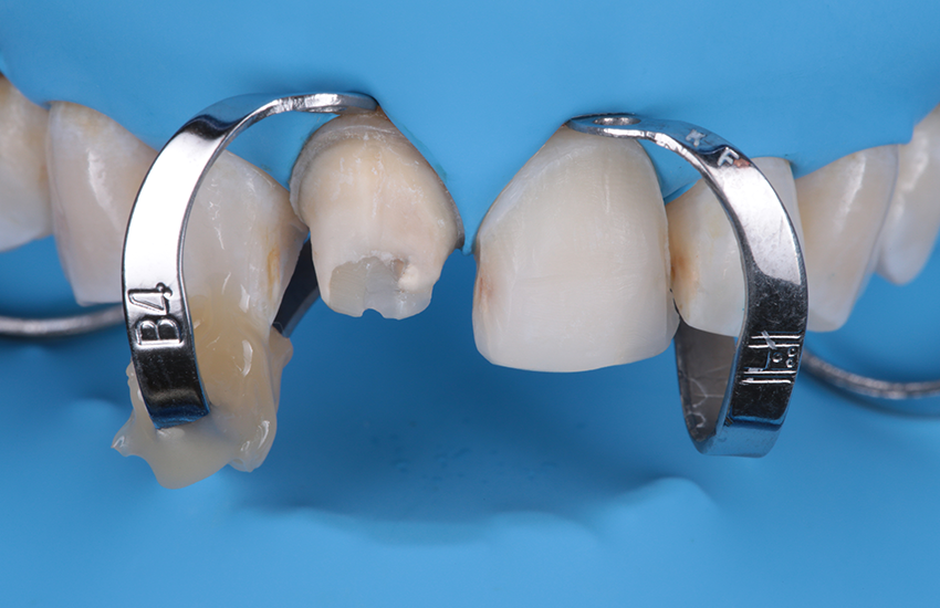 Präparationen isoliert mit Kofferdam Präparationen isoliert mit Kofferdam