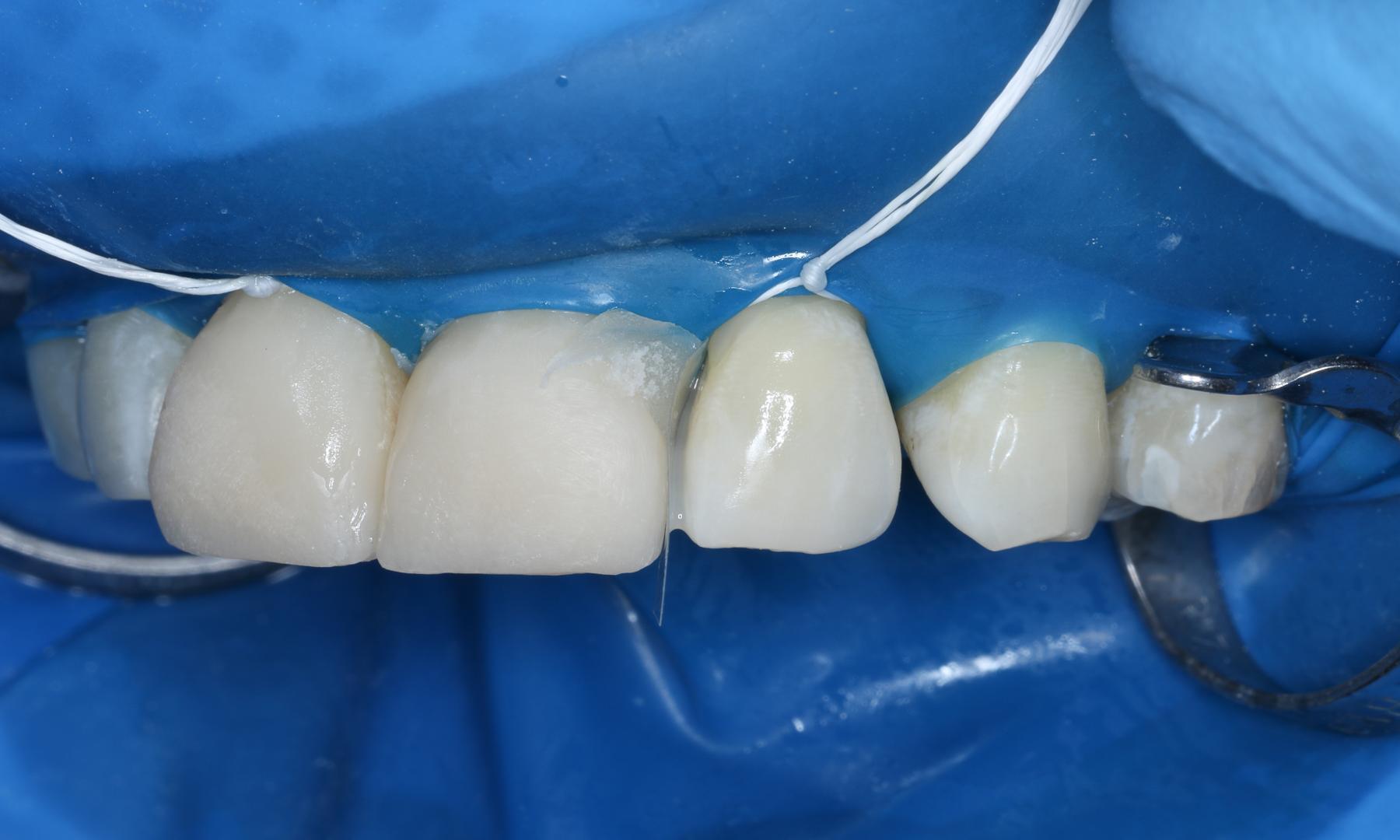 Ansicht der Zähne von lateral