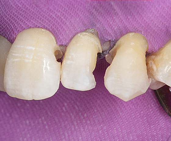 Vestibuläre Ansicht präparierter Zähne von vestibular