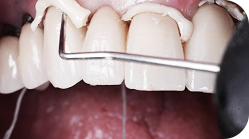 Entfernung von überschüssigem 3M™ RelyX™ Universal Befestigungskomposit Entfernung von überschüssigem 3M™ RelyX™ Universal Befestigungskomposit