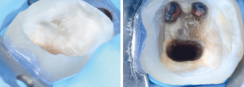 Bild eines endodontisch behandelten Molaren vor der Restauration Bild eines endodontisch behandelten Molaren vor der Restauration
