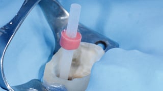 Einprobe des Wurzelstifts zur Längenbestimmung Einprobe des Wurzelstifts zur Längenbestimmung