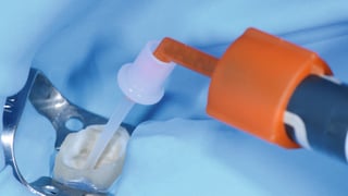 Applikation von 3M™ RelyX™, in den Wurzelkanal mit Verlängerungskanüle. Applikation von 3M™ RelyX™, in den Wurzelkanal mit Verlängerungskanüle.