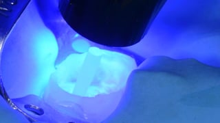 Lichthärtung nach dem Einsetzen des Wurzelstifts Lichthärtung nach dem Einsetzen des Wurzelstifts