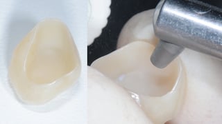 Sandstrahlen der Zirkoniumoxid-Krone Sandstrahlen der Zirkoniumoxid-Krone