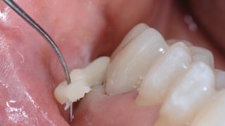 Entfernen von überschüssigem Zement mit einer Sonde Entfernen von überschüssigem Zement mit einer Sonde