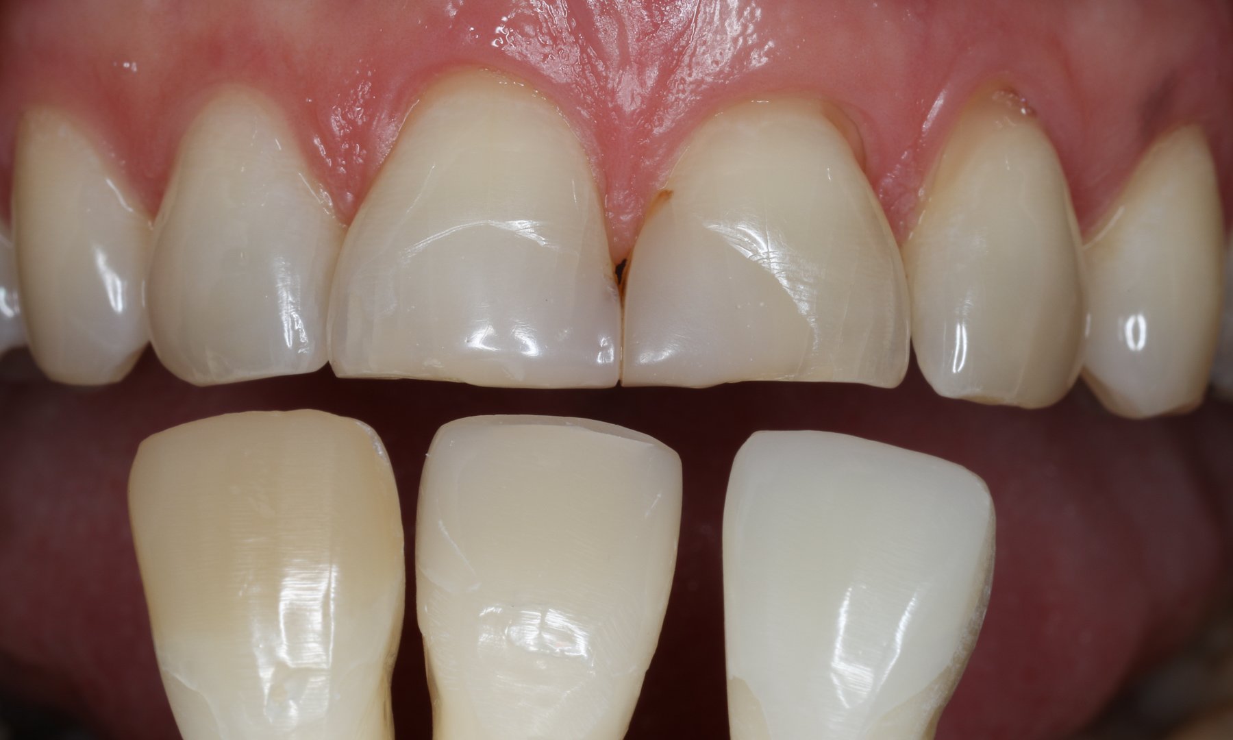 Farbauswahl der Zahnfarbe