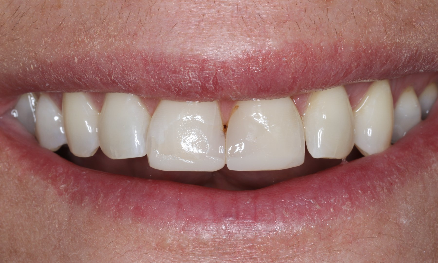 Überprüfung der gewählten Zahnfarbe