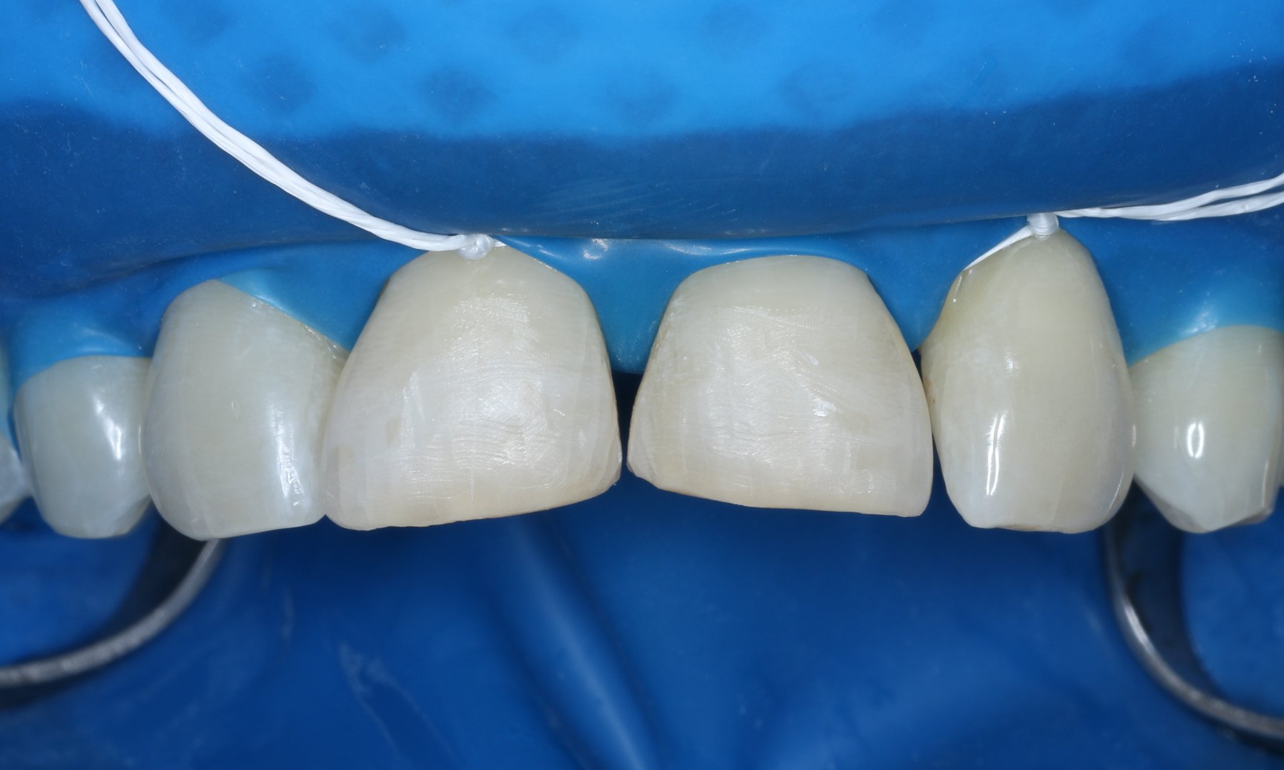 Absolute Trockenlegung der Zähne mit Kofferdam