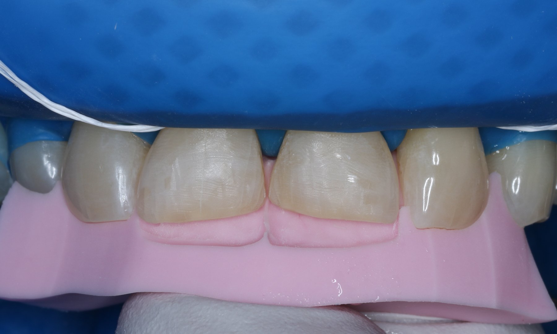 Einprobe des Silikonschlüssels zur Passungskontrolle