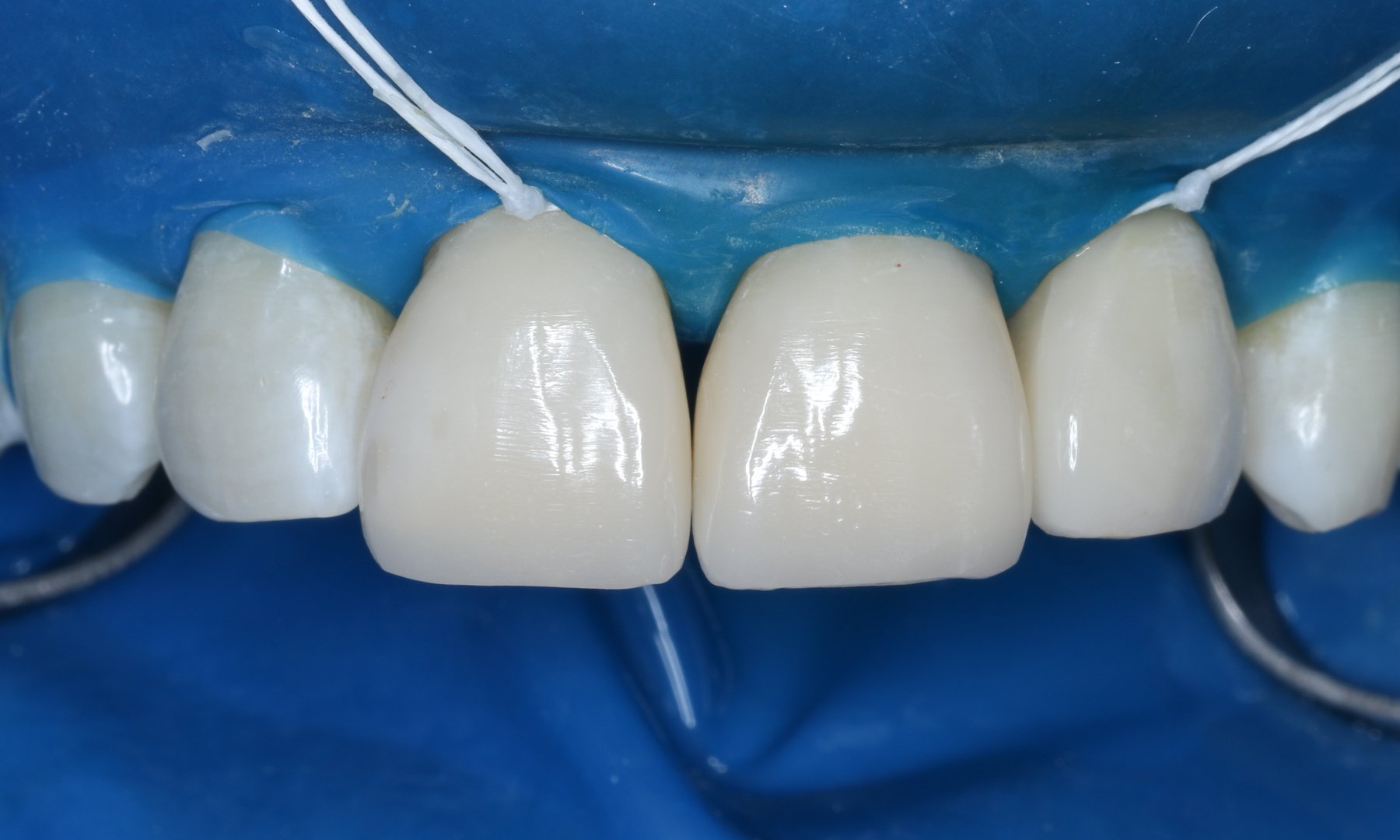 Frontalansicht der Zähne