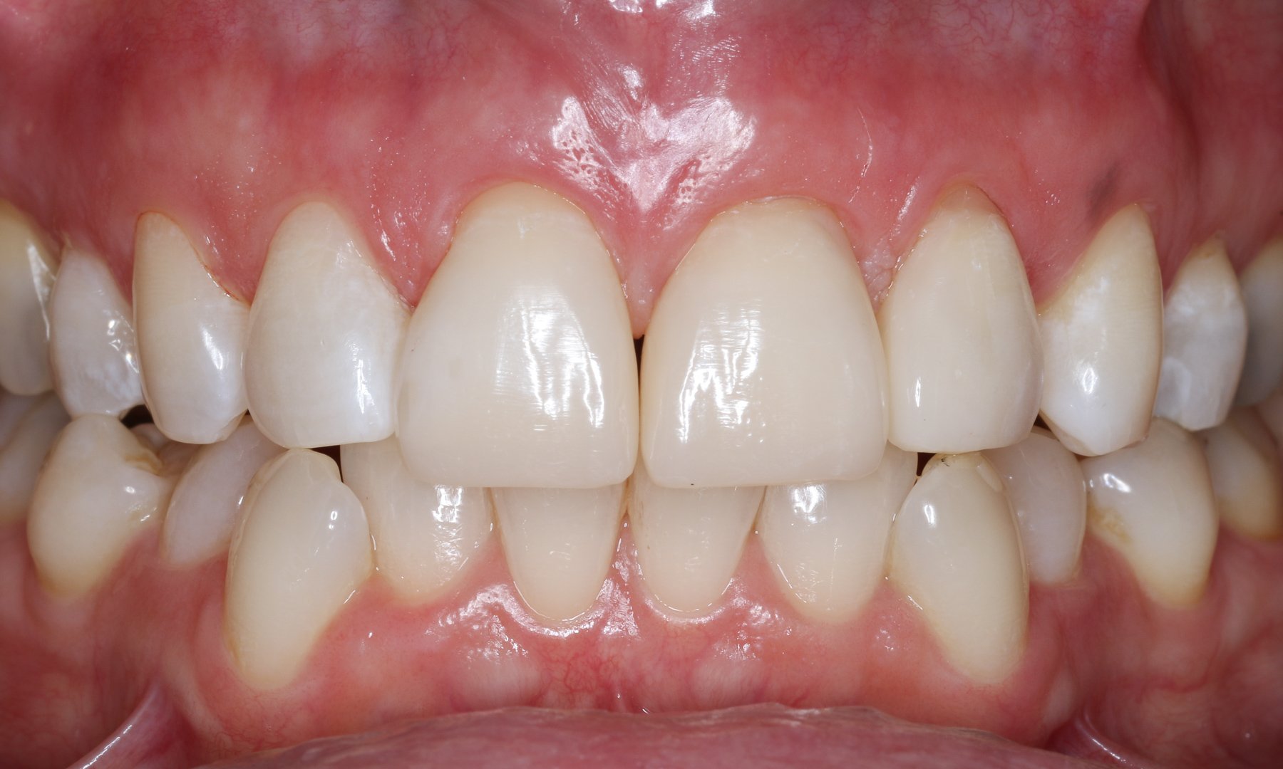 Postoperative Aufnahme der Zähne in Okklusion