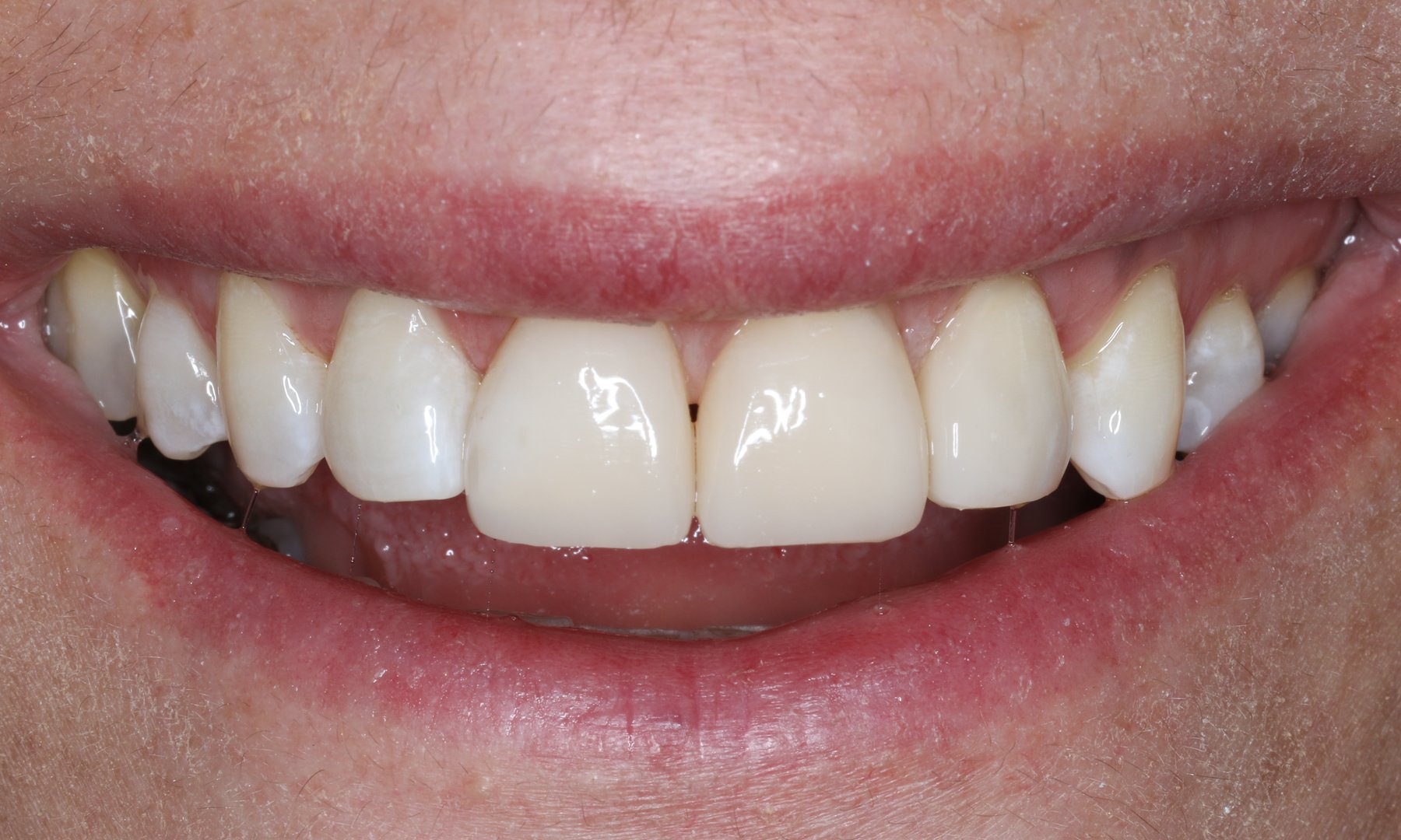 Lächeln der Patientin unmittelbar nach der Behandlung