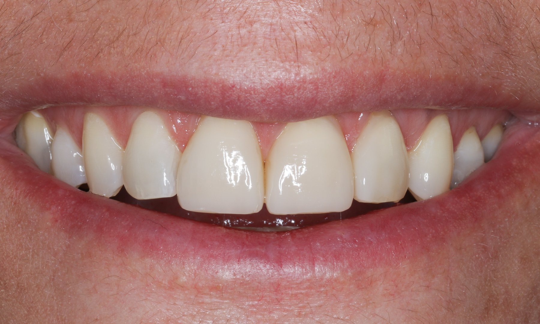 Lächeln der Patientin nach vier Wochen