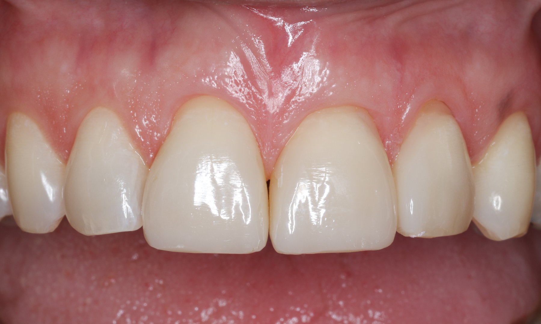 Ergebnis der Zähne nach vier Wochen