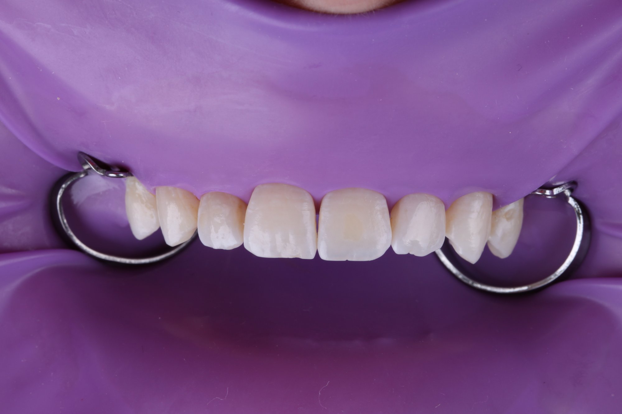 Isolierung der Zähne mit Kofferdam