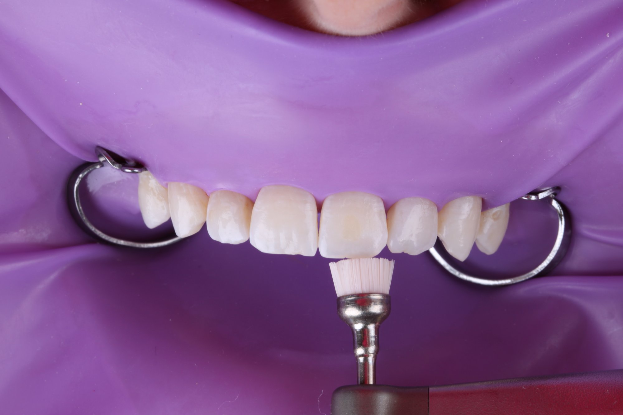 Biofilm wird mit Bimssteinpaste und Prophylaxebürste entfernt