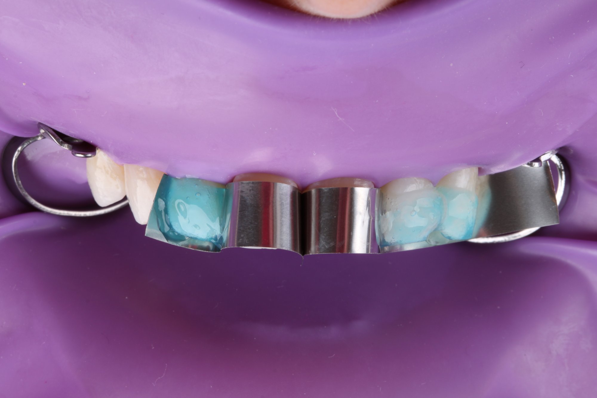 Ätzen der Zähne mit Phosphorsäure-Gel