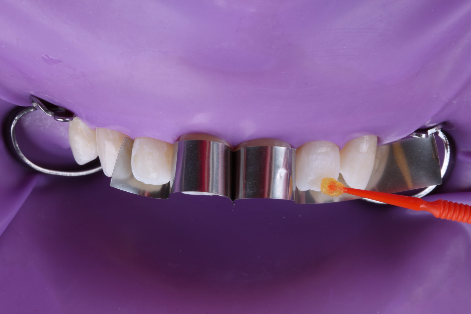 Anwendung von 3M™ Scotchbond™ Universal Plus Adhäsiv auf den Zähnen