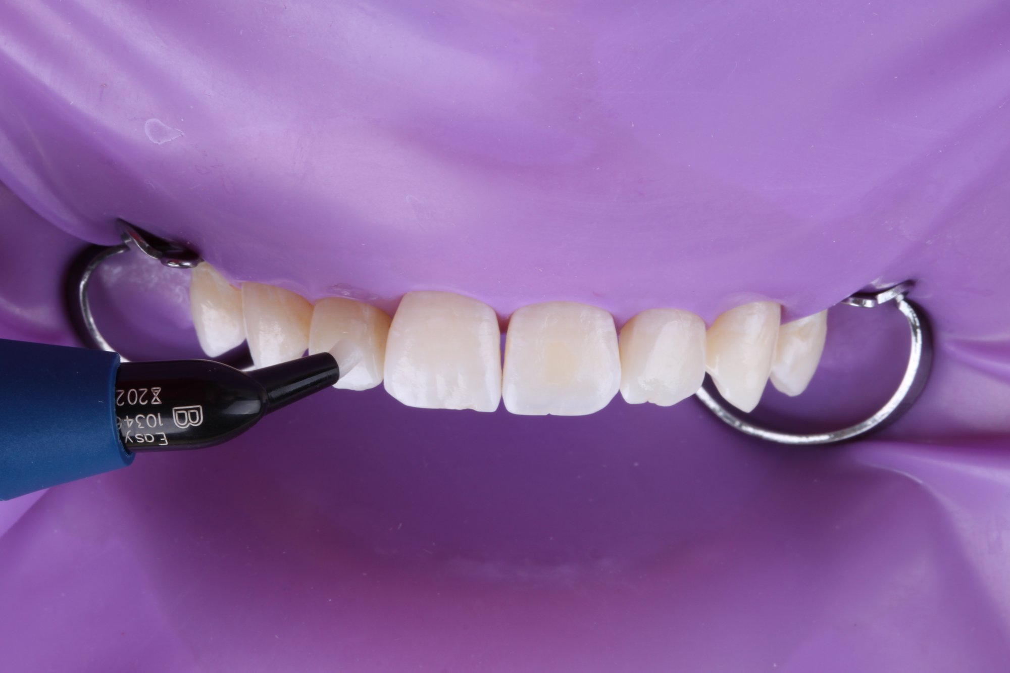 Applikation von 3M™ Filtek™ Easy Match, Farbton Bright auf den Zähnen