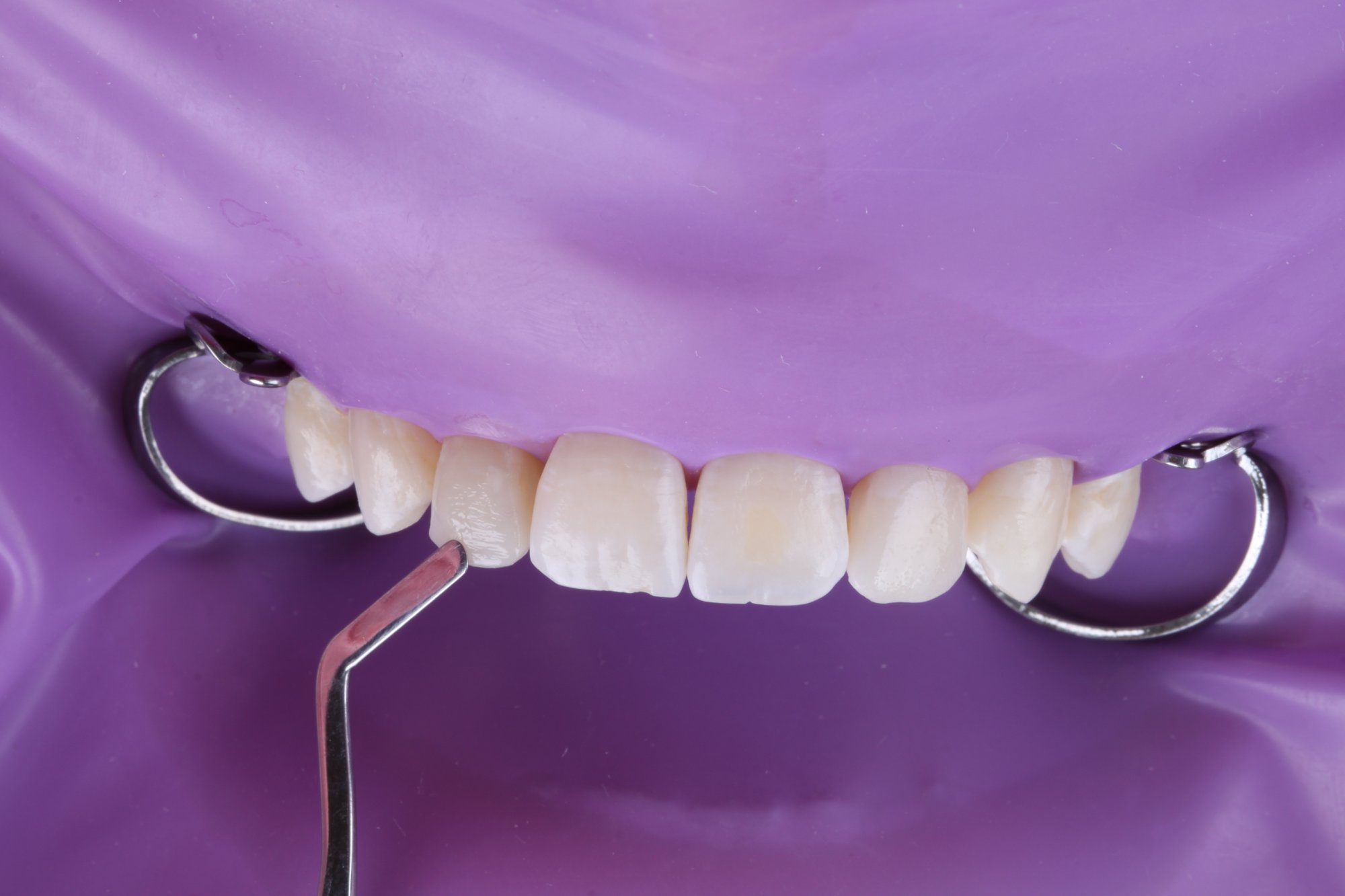 Anatomische Modellation des Zahns 12 mit einem Spatel