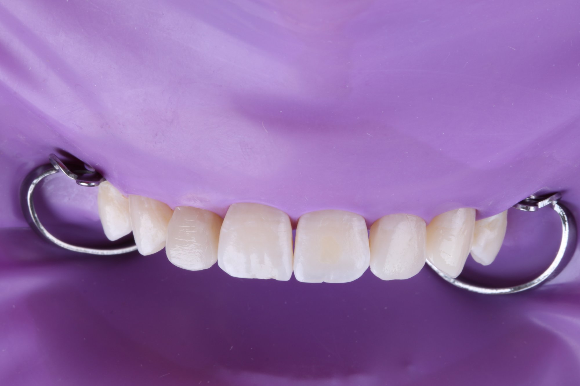 Ausgearbeitete Restaurationen der Zähne vor der Politur.