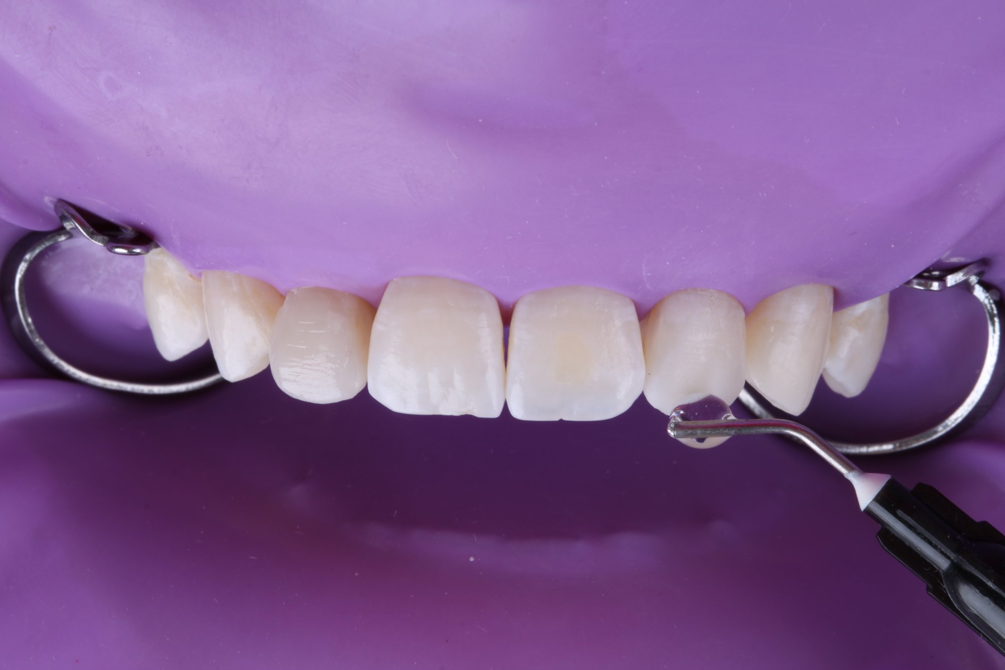 Glyceringel vor Lichthärtung auf den Zähnen aufgetragen