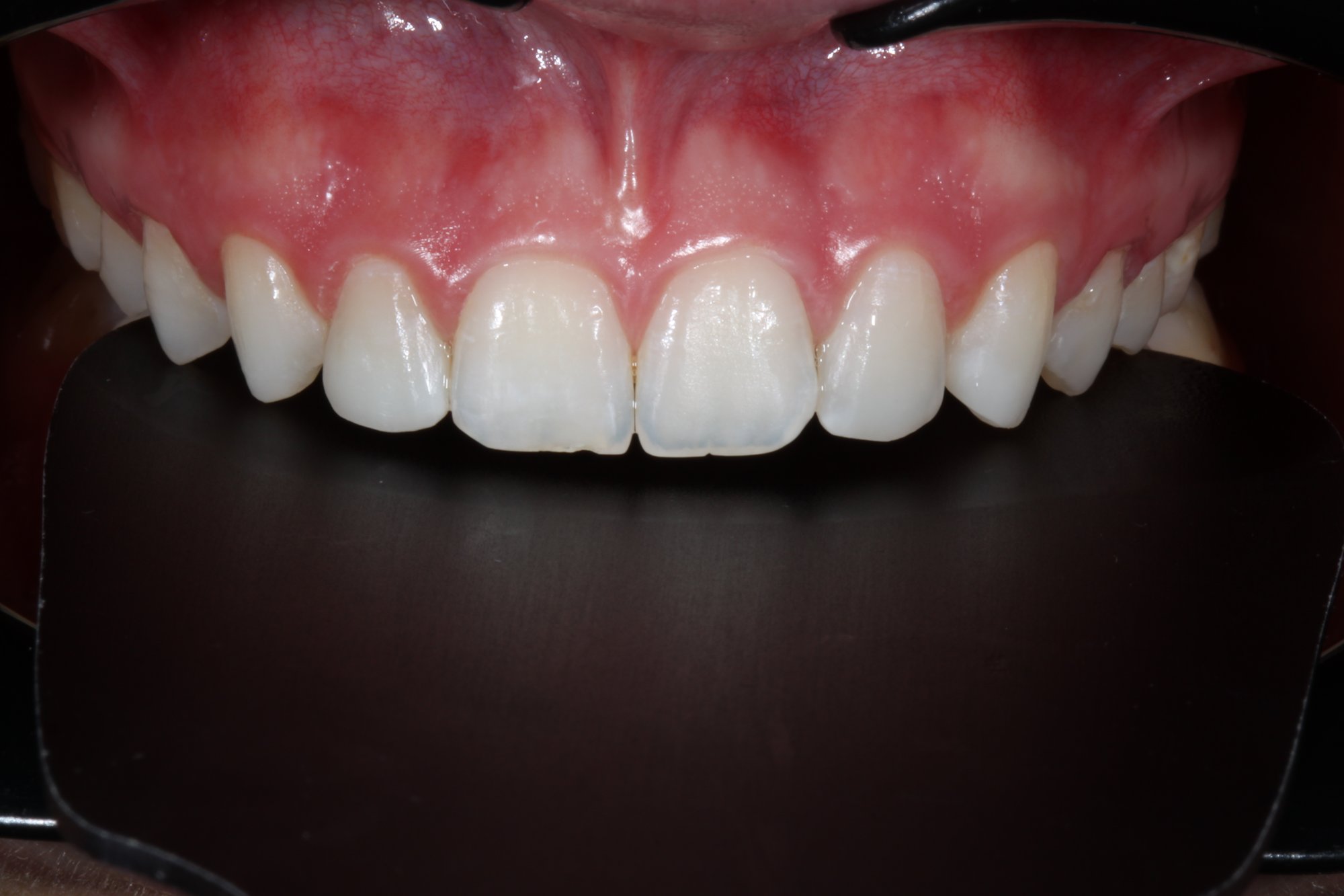 Zähne nach Ausarbeitung und Politur mit 3M™ Sof-Lex™ Scheiben und Rädern