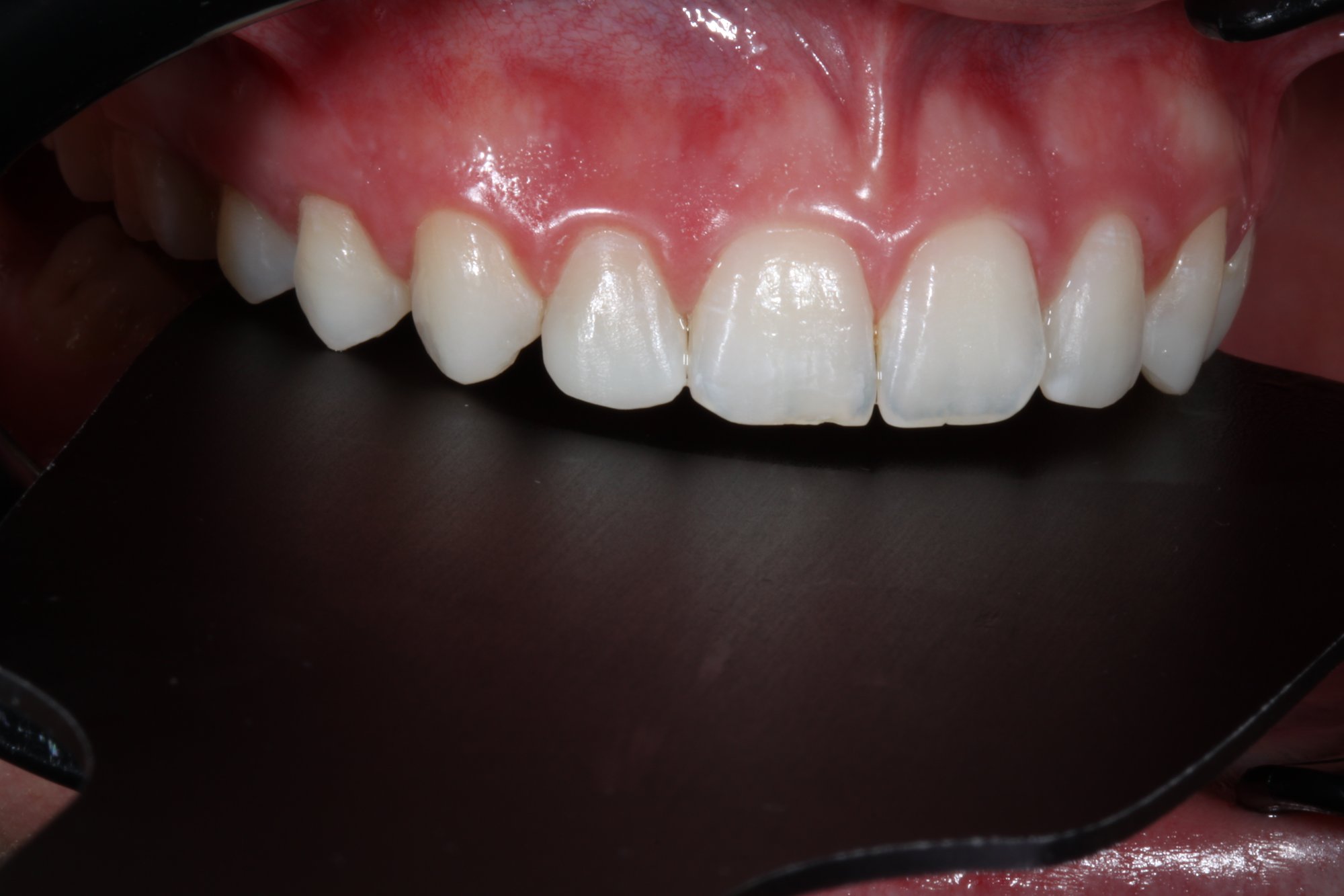 Definitive Restaurationen der Zähne: Ansicht von lateral.