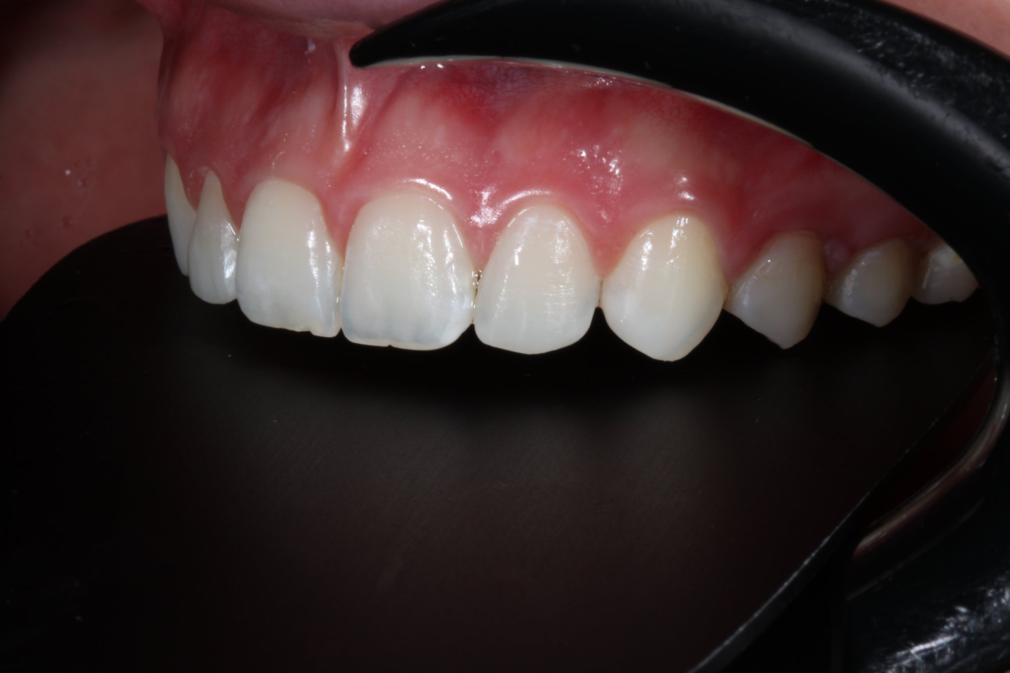 Definitive Restaurationen der Zähne: Ansicht von lateral. 