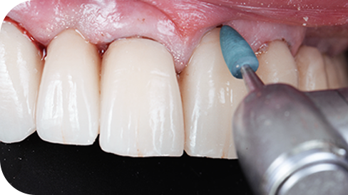 Saubere Restaurationsränder nach der Politur Saubere Restaurationsränder nach der Politur