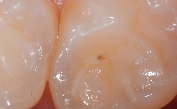 Häufig auftretende Blase in einer Fissurenversiegelung der Zähne Häufig auftretende Blase in einer Fissurenversiegelung der Zähne