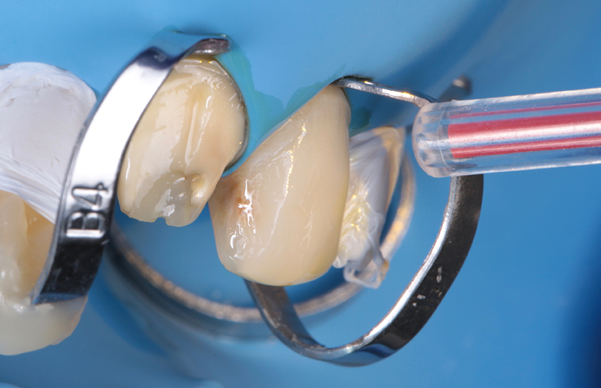 Lufttrocknen von 3M™ Scotchbond™ Universal Plus Adhäsiv Lufttrocknen von 3M™ Scotchbond™ Universal Plus Adhäsiv