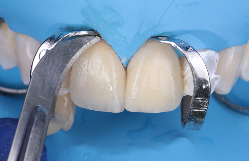 Überschüssiges Befestigungskomposit mit Klinge entfernt. Überschüssiges Befestigungskomposit mit Klinge entfernt.