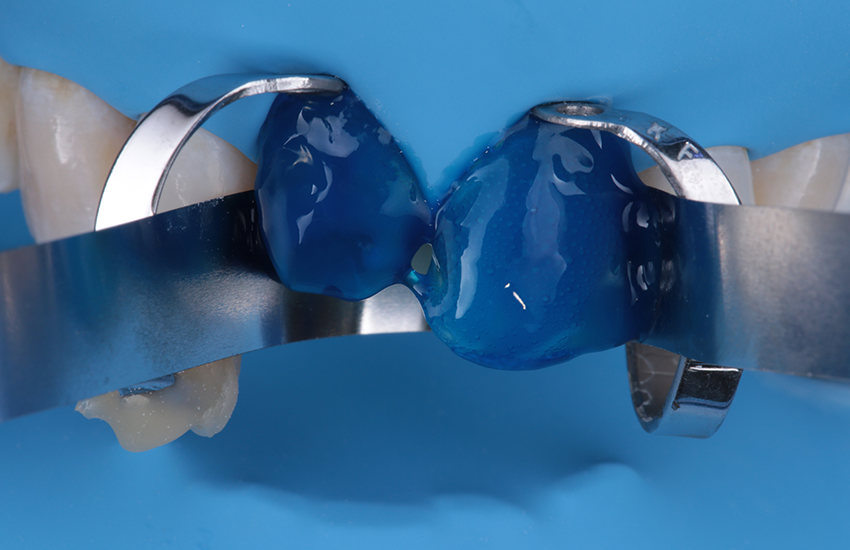 Ätzen der Präparationen mit Phosphorsäure Ätzen der Präparationen mit Phosphorsäure