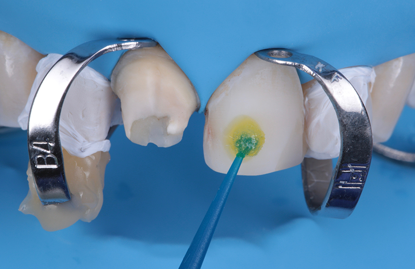 Auftragen von 3M™ Scotchbond™ Universal Plus Adhäsiv Auftragen von 3M™ Scotchbond™ Universal Plus Adhäsiv