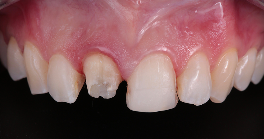 Veneer- und Kronenpräparationen an Zähnen 11 und 12 für Einprobe vorbereitet Veneer- und Kronenpräparationen an Zähnen 11 und 12 für Einprobe vorbereitet