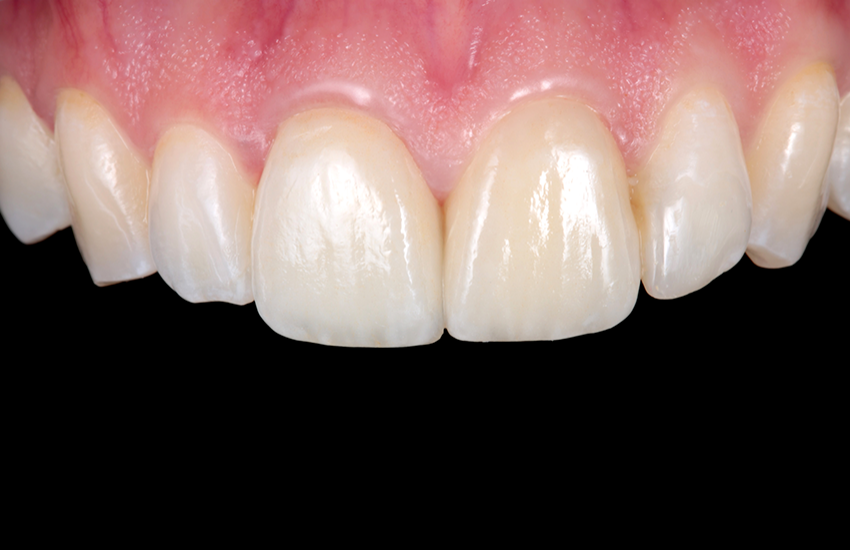 Ergebnis zwei Monate nach Behandlungsabschluss Ergebnis zwei Monate nach Behandlungsabschluss