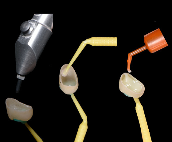 Vorbehandlung der Zahnkrone mit Komposit Vorbehandlung der Zahnkrone mit Komposit