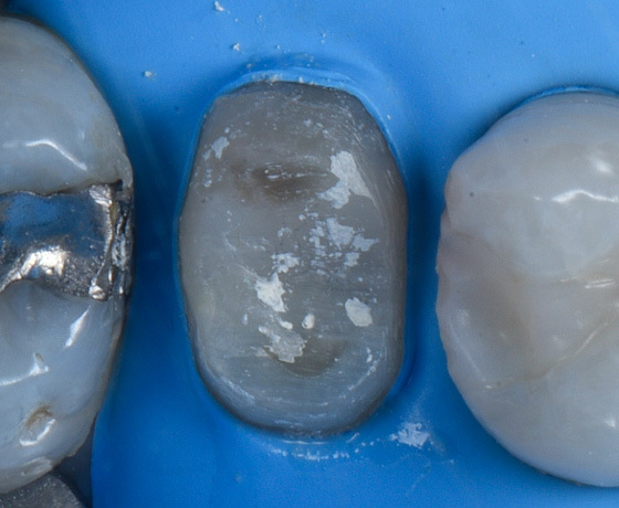 Zähne bei Trockenlegung mit Kofferdam Zähne bei Trockenlegung mit Kofferdam