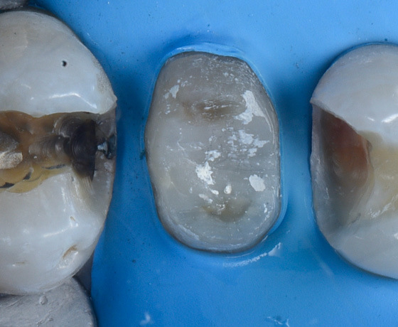 Zähne nach Entfernung von Amalgam und Komposit Zähne nach Entfernung von Amalgam und Komposit