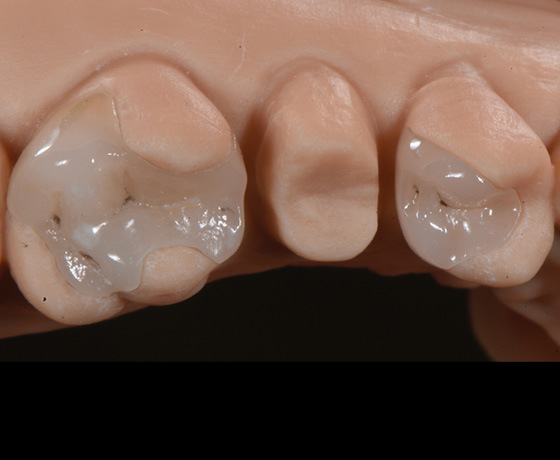 CAD/CAM-Teilrestaurationen am Zahn CAD/CAM-Teilrestaurationen am Zahn