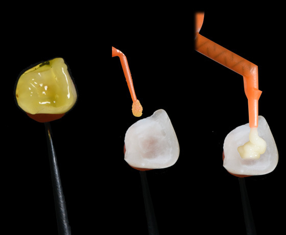 Vorbehandlung der Zahnkrone mit Flusssäure, Spülen und Auftrag von Scotchbond™ Universal Plus und RelyX™ Universal Komposit Vorbehandlung der Zahnkrone mit Flusssäure, Spülen und Auftrag von Scotchbond™ Universal Plus und RelyX™ Universal Komposit