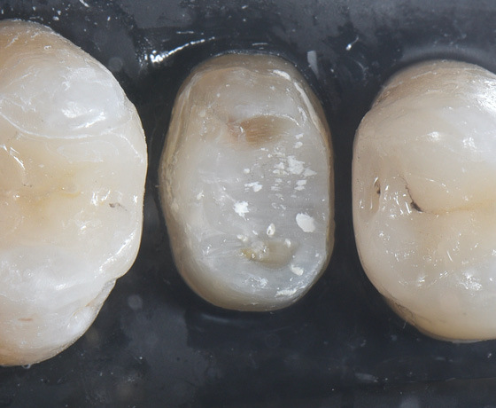 Adhäsiv eingegliederte Teilrestaurationen am Zahn Adhäsiv eingegliederte Teilrestaurationen am Zahn