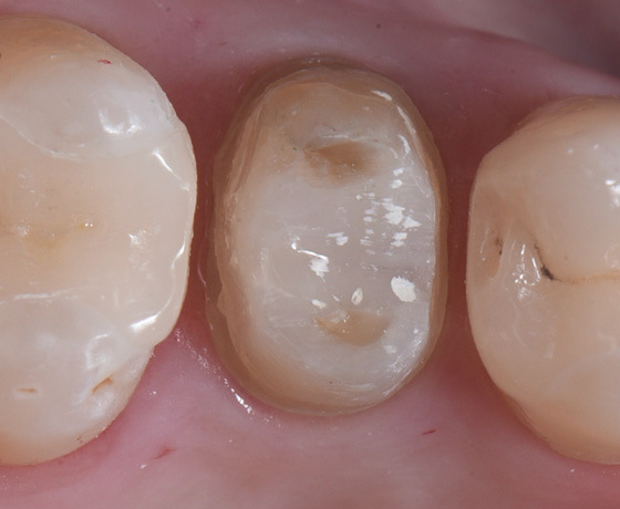 Zahn 25 mit optimaler Präparationsgrenze präpariert Zahn 25 mit optimaler Präparationsgrenze präpariert