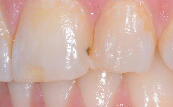 Kleine Blase im Komposit verfärbt Kleine Blase im Komposit verfärbt