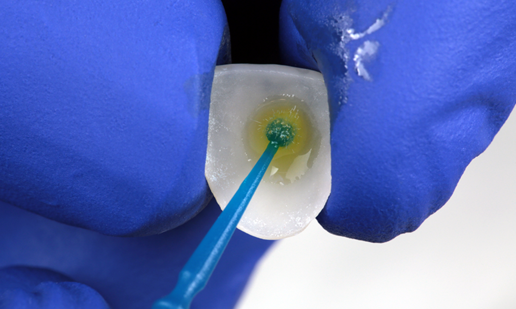 3M™ Scotchbond™ Universal Plus Adhäsiv als Silan auf geätztes Glaskeramik-Veneer aufgetragen. 3M™ Scotchbond™ Universal Plus Adhäsiv als Silan auf geätztes Glaskeramik-Veneer aufgetragen.